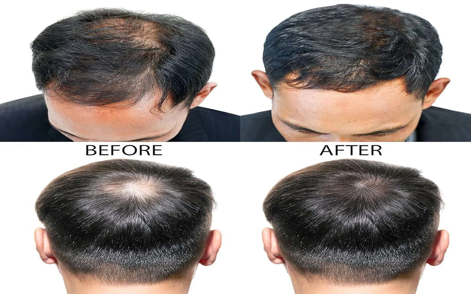 Hair Regrowth Solutions That Actually Work