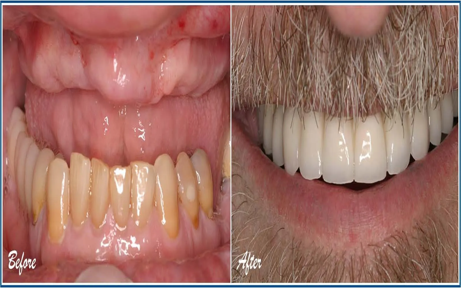 Affordable Dental Implant Options to Rebuild Your Smile