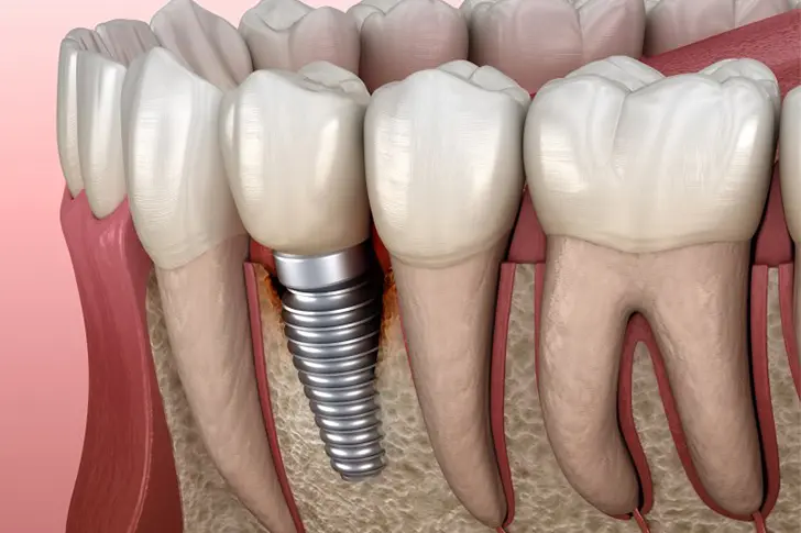 How To Find Cheap Dental Implant