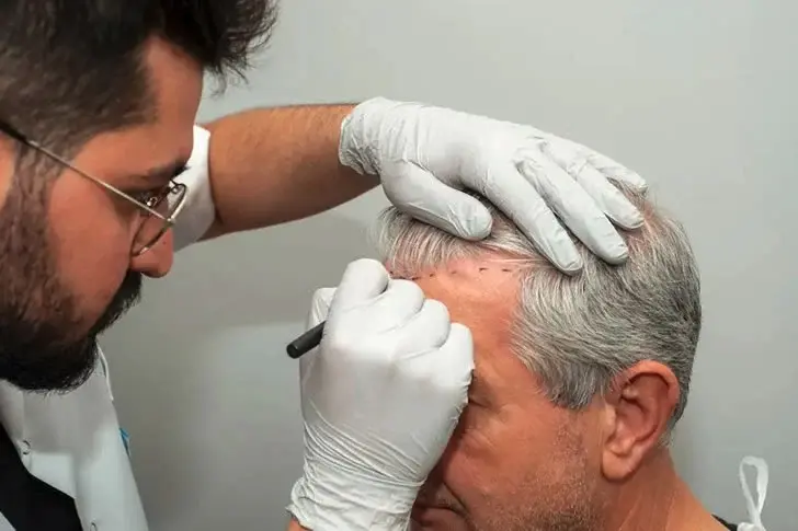 US Seniors : How To Find Cheap Hair Transplant Near You